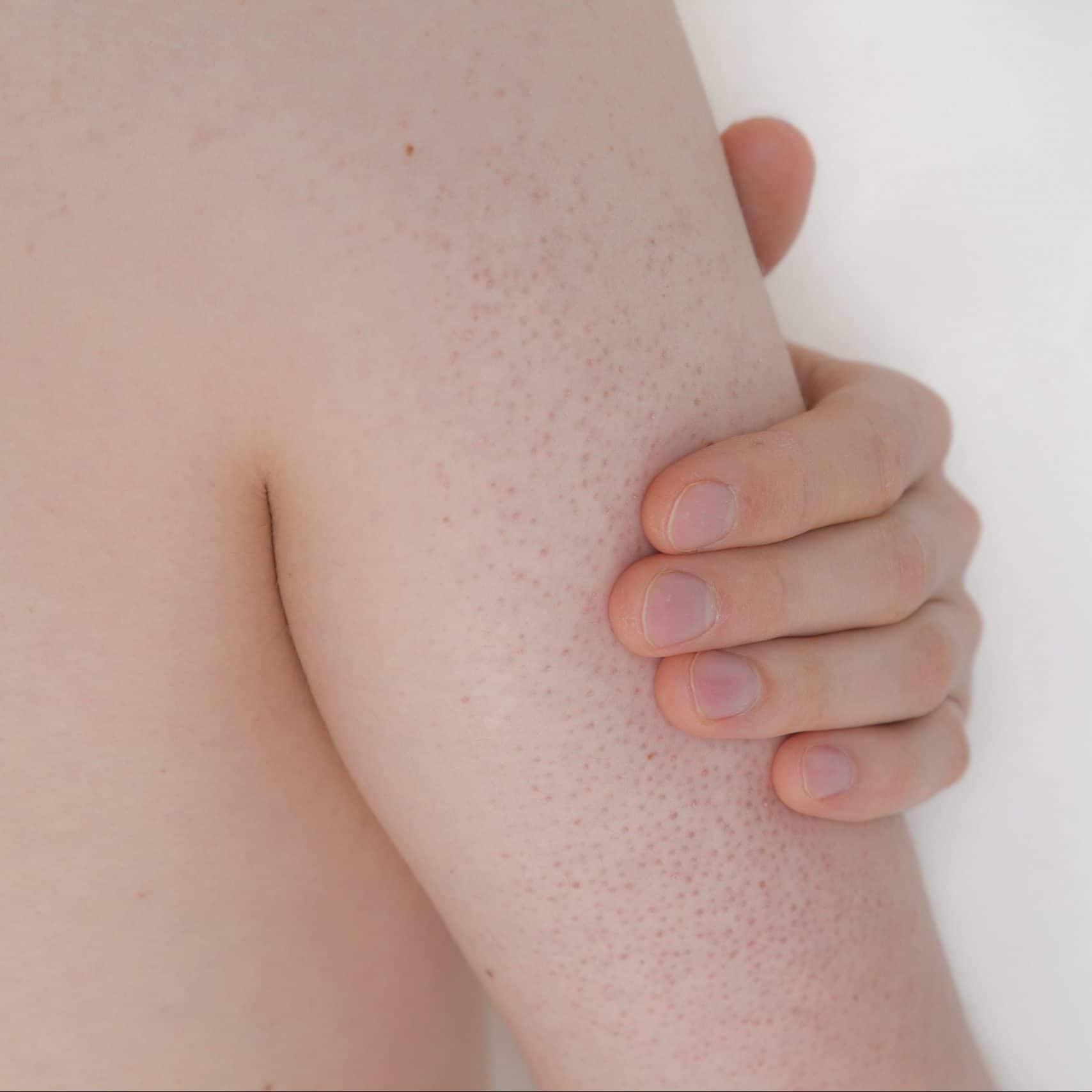 Keratosis pilaris behandeling in enschede