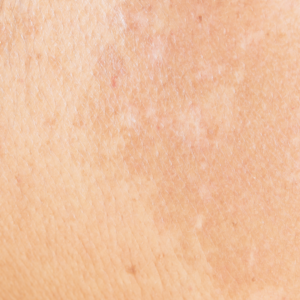 melasma behandeling