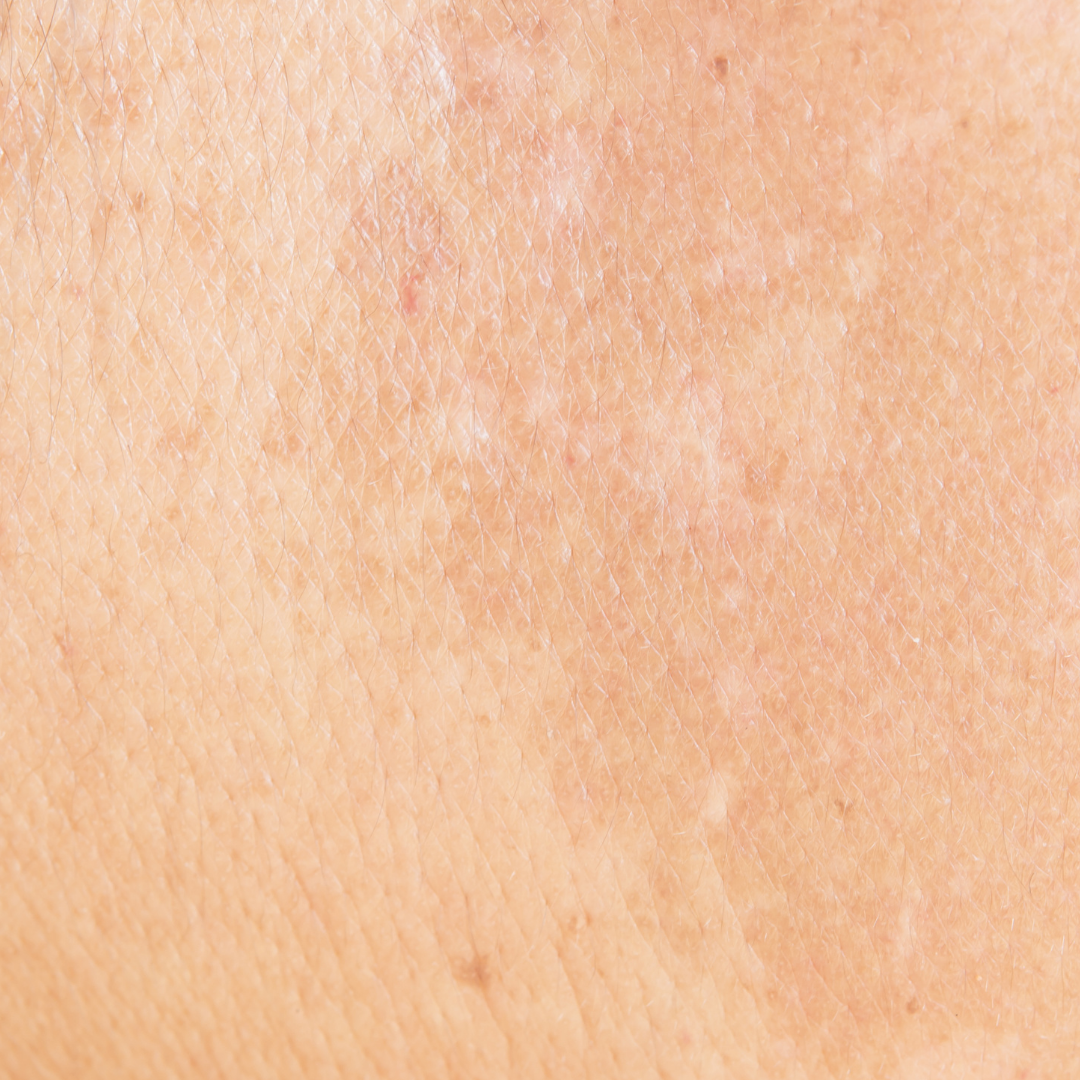 melasma behandeling