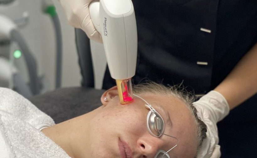 resurfx laser behandeling