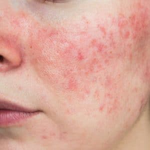 rosacea behandelen