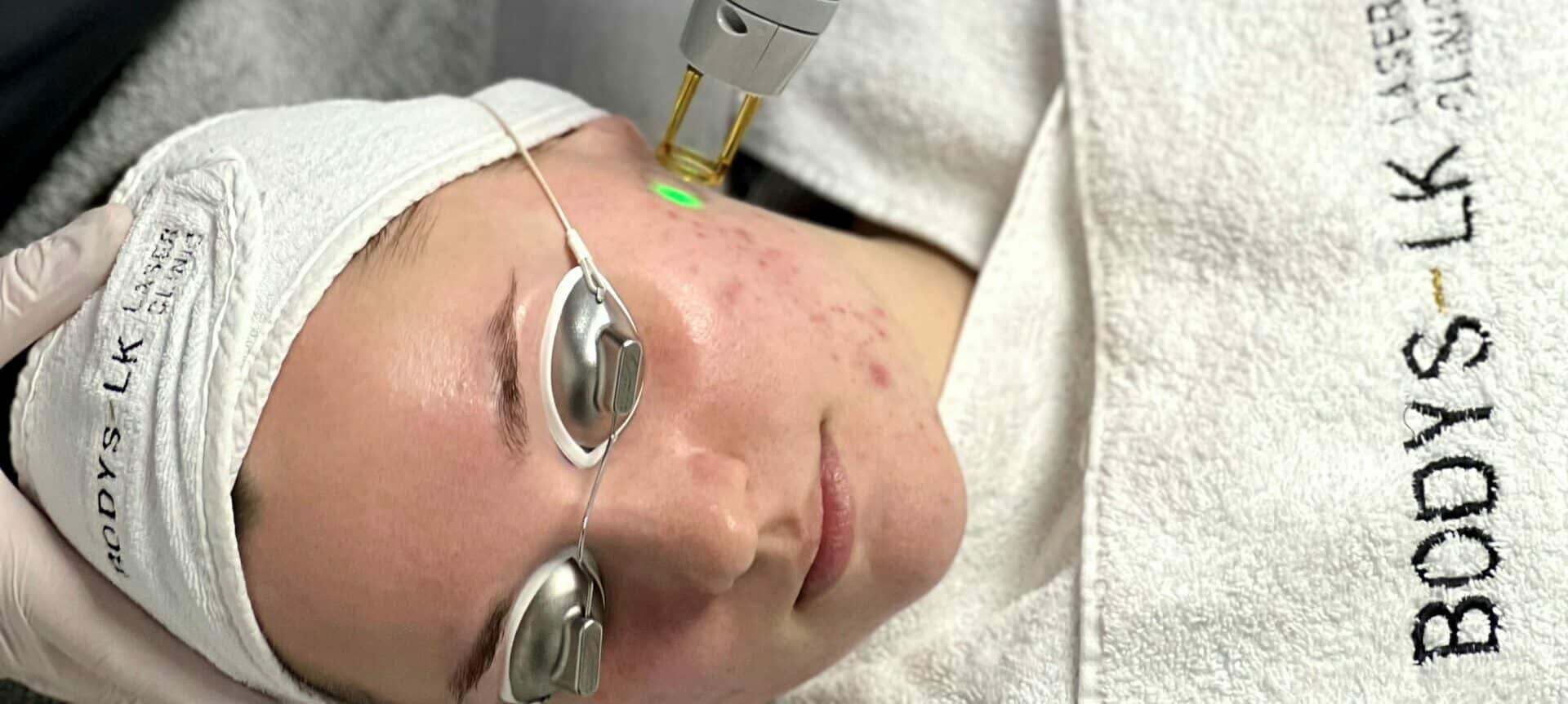 acne therapie met laser