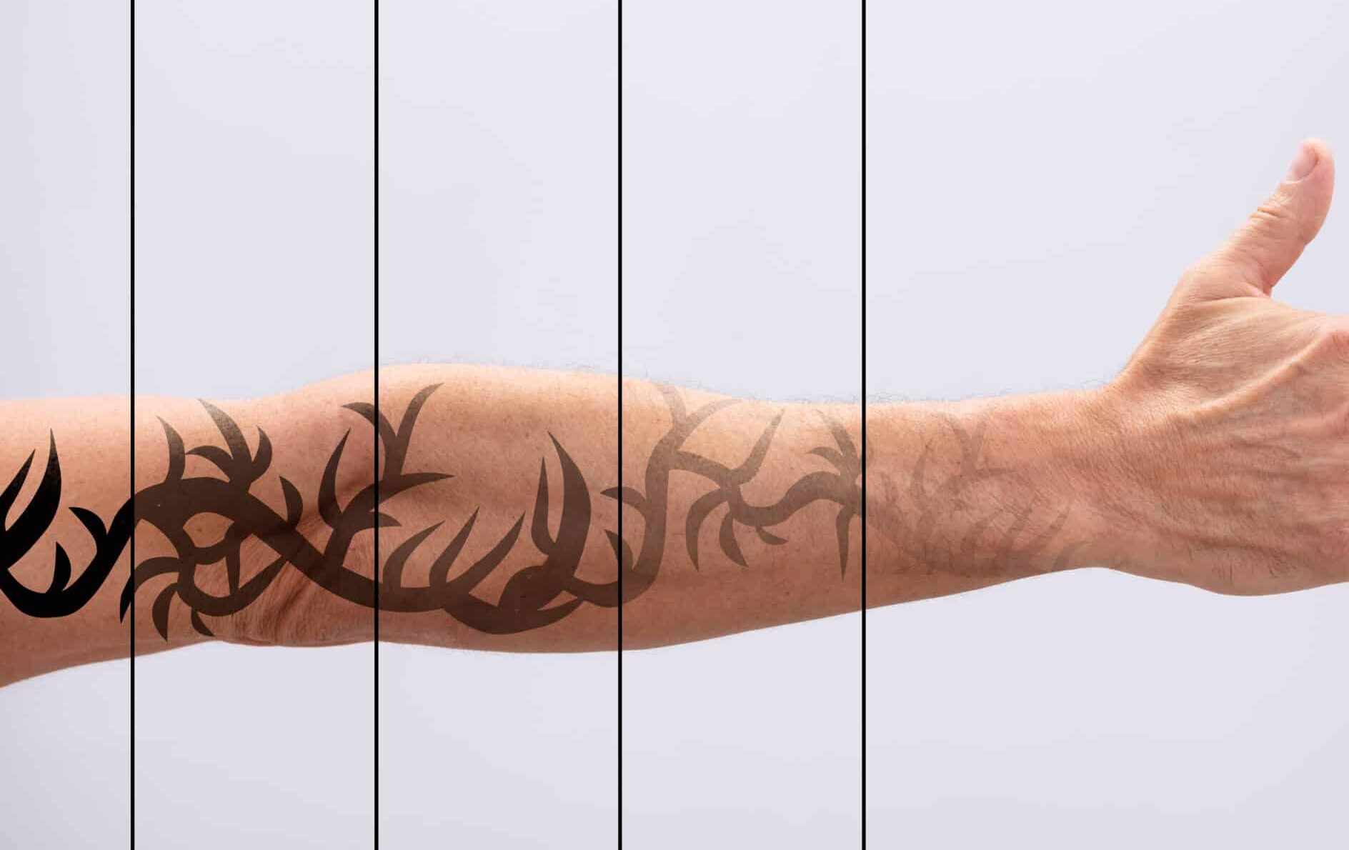 Kosten tattoo verwijderen