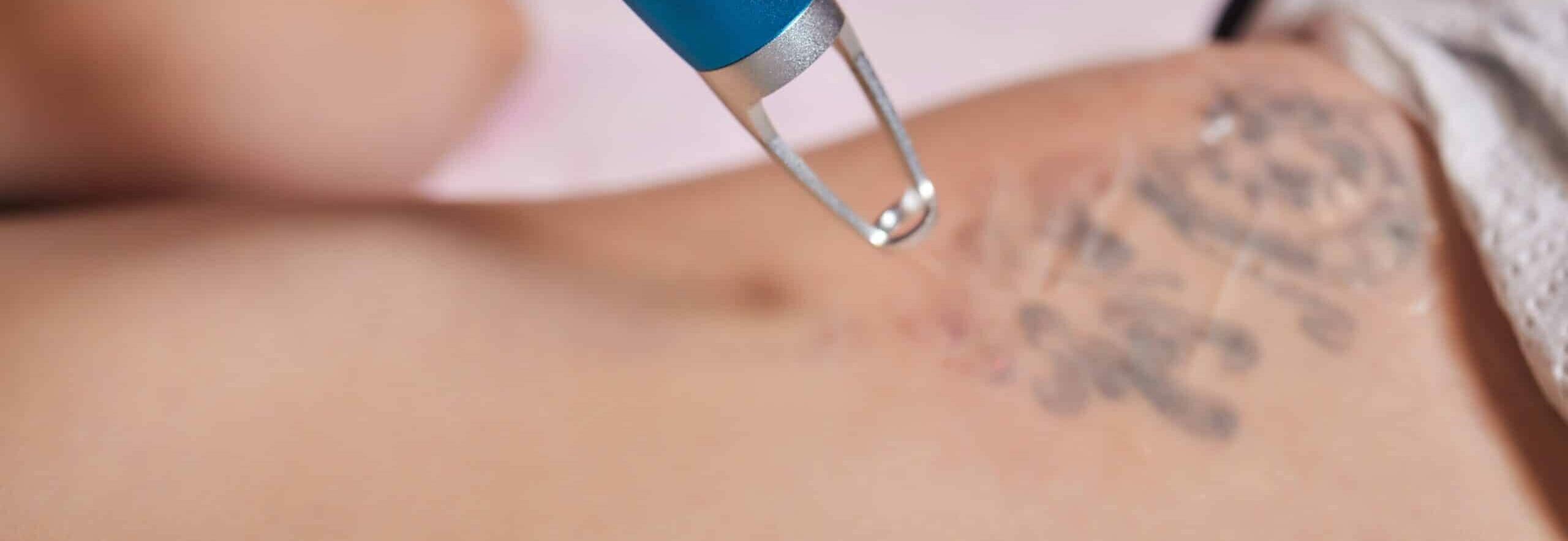 pico laser om tatoeage te verwijderen