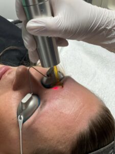 permanente make up of PMU verwijderen met Pico laser tattoo removal