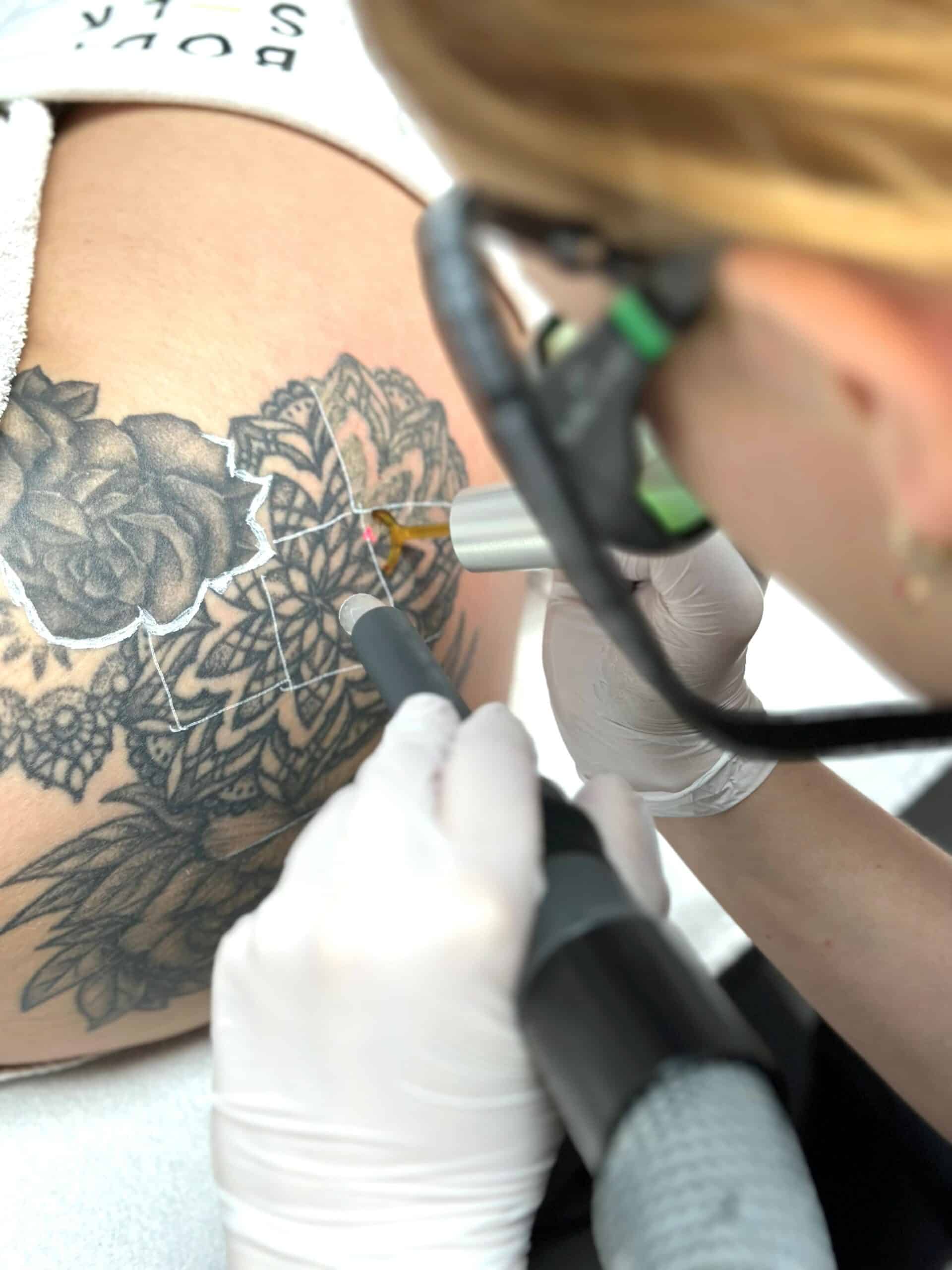 grote en kleine tatoeages verwijderen zonder pijn