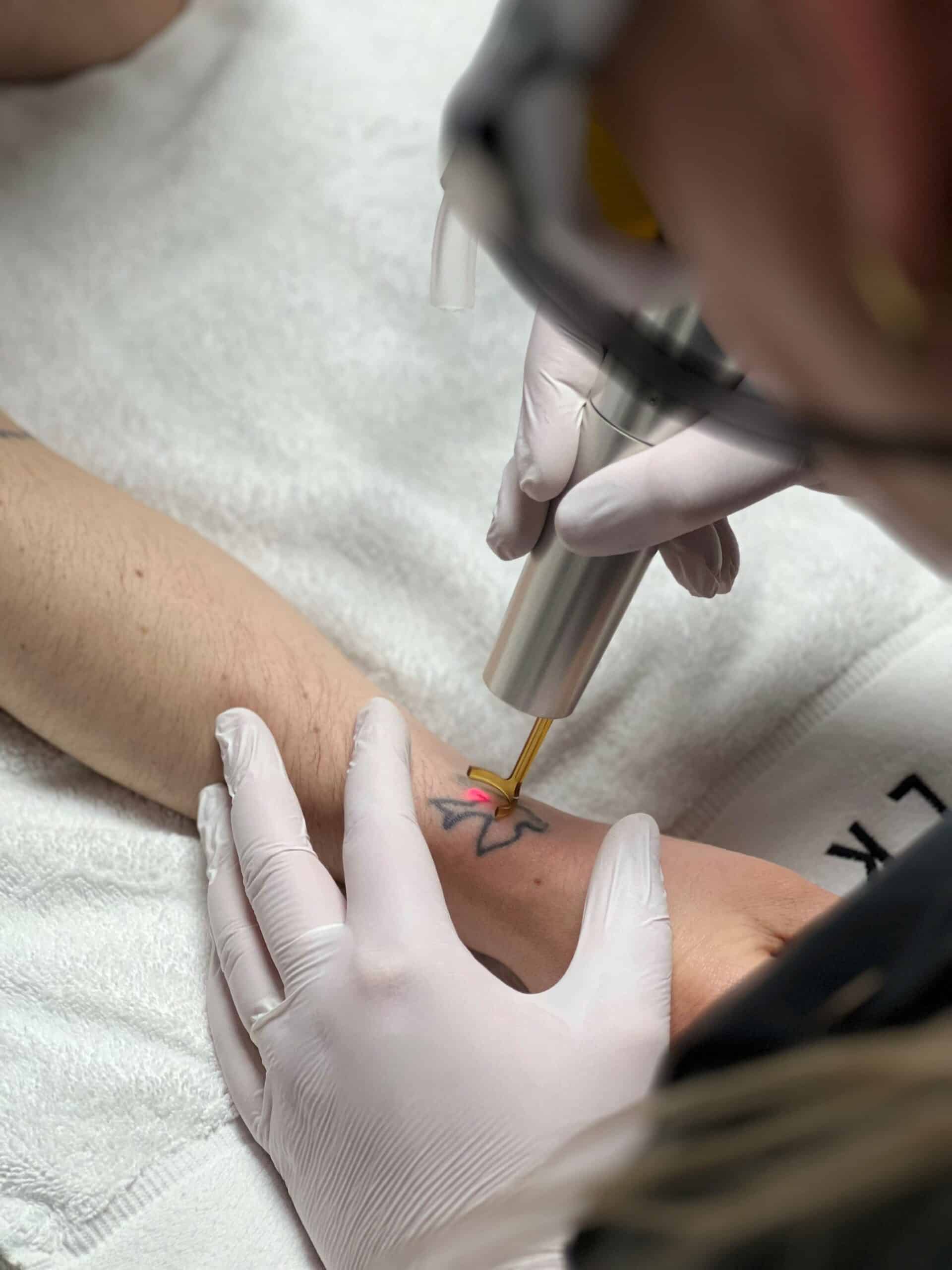 picolaser tattoo verwijderaar